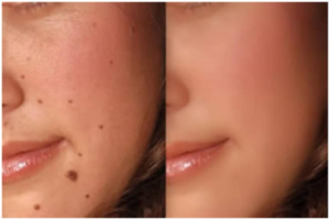 How to get rid of unsightly moles and regain your confidence